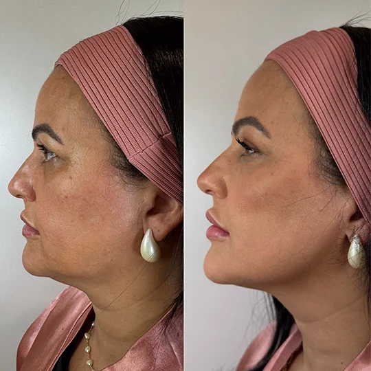 Antes e Depois