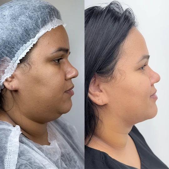 Antes e Depois