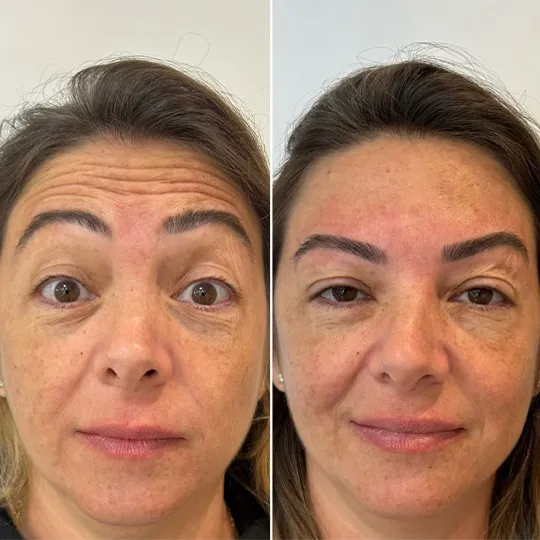 Antes e Depois
