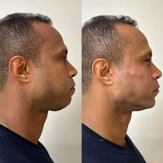 Antes e Depois