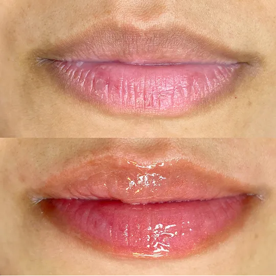 Antes e Depois