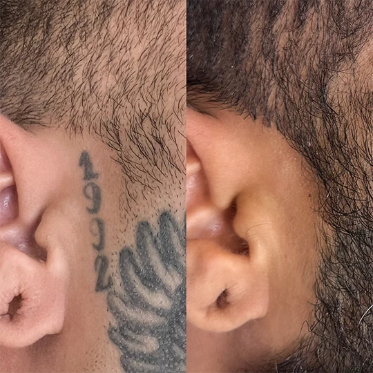 Antes e Depois